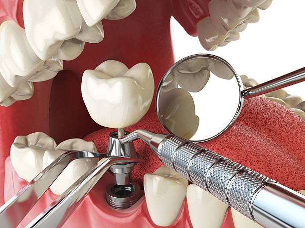 Best Knocked-Out Tooth (Avulsed Tooth) Treatment in Seymour, TN